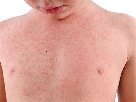 meningitis symptoms in children rash